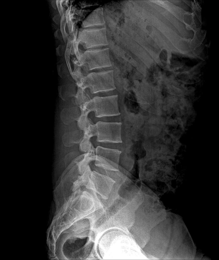 Xray of bent spinal cord